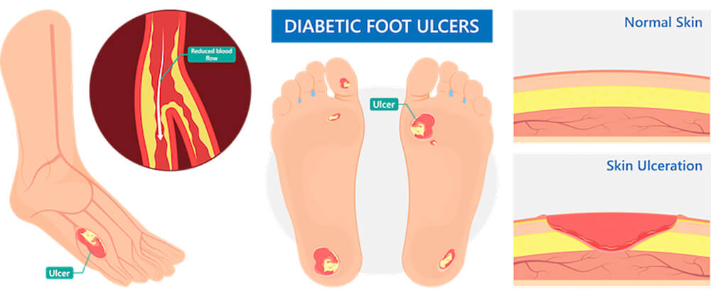 https://gaitway.com.au/wp-content/uploads/2021/05/foot-ulcer-image.jpg